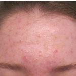 Acne Skin