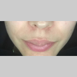Acne Skin