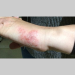 Eczema Skin