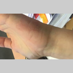 Eczema Skin