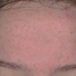 Acne Skin