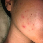Acne skin
