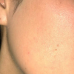 Acne skin