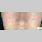 Acne skin
