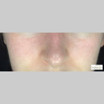 Acne Skin