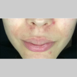 Acne Skin
