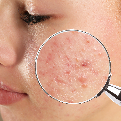 Acne, spots