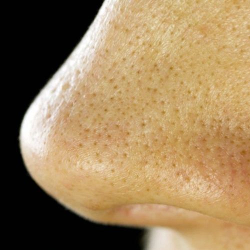 Blackheads, Spots, Sebaceous Filaments, whiteheads