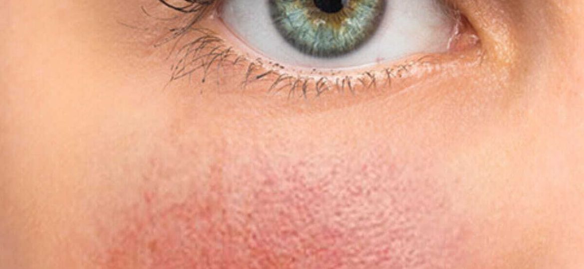 Rosacea