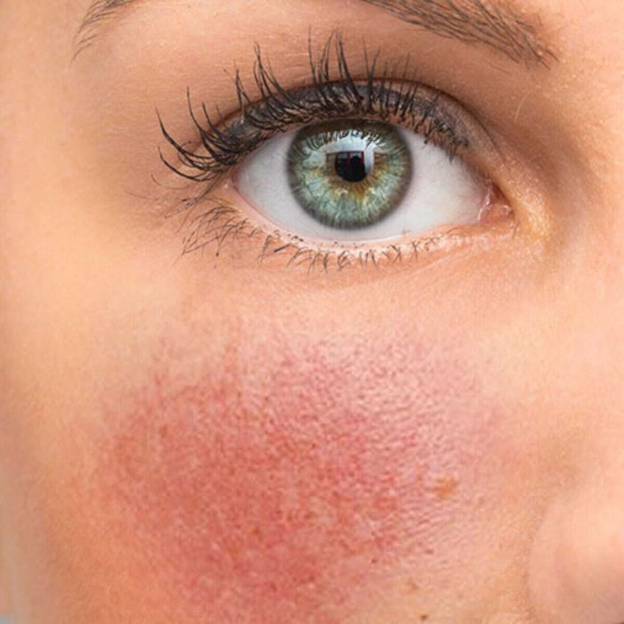 Rosacea