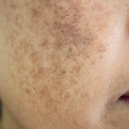 Hyperpigmentation