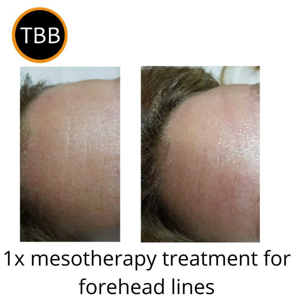 Mesotherapy treatment for forehead lines