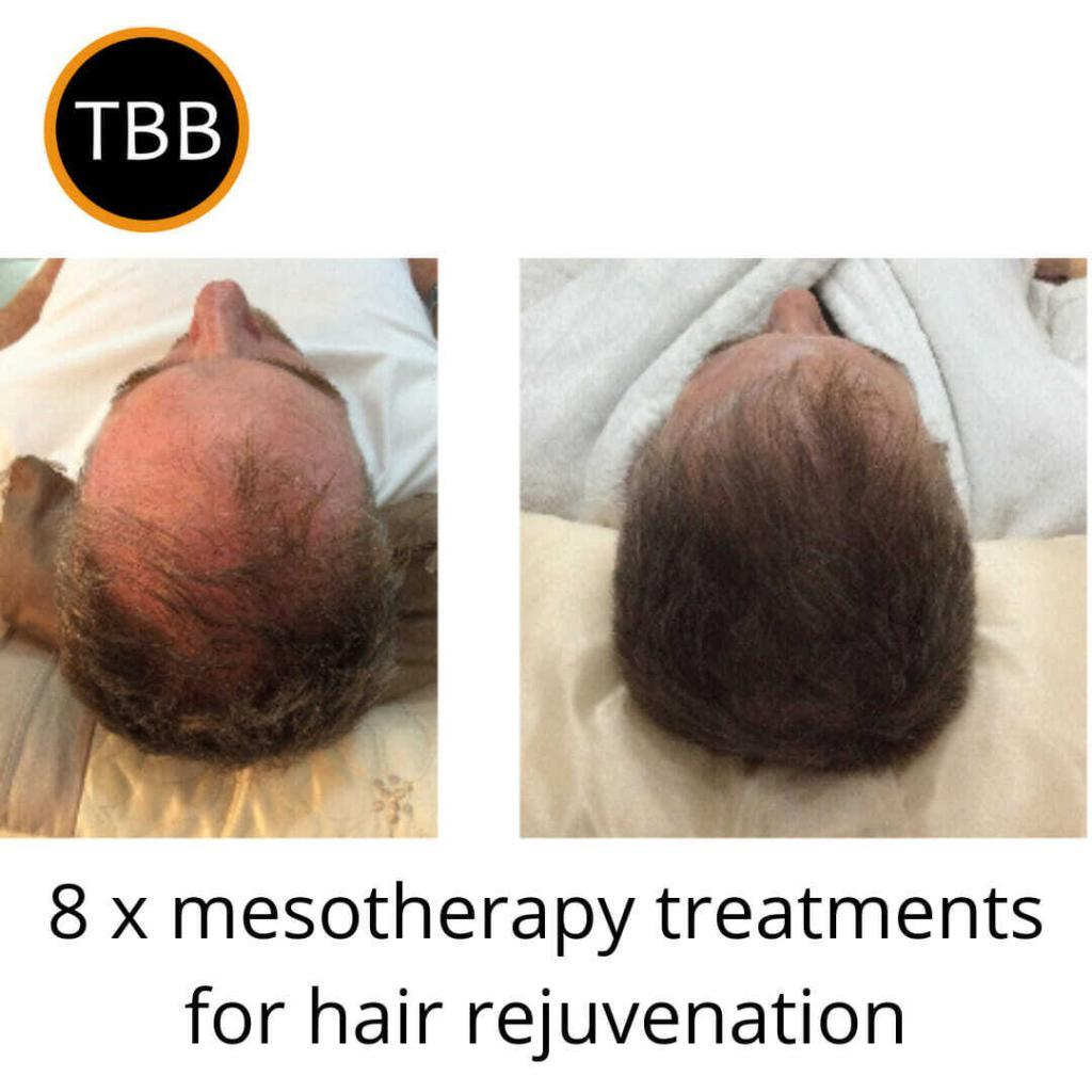 Mesotherapy hair rejuvenation
