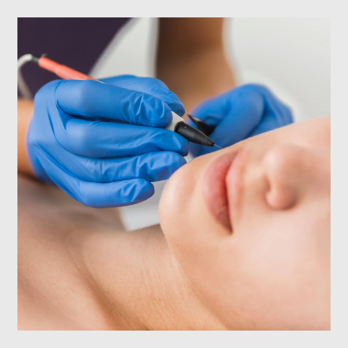 Blemish removal, pigmentaiton removal, thread vein removal, advanced cosmetic procedures, skin tags, thread vein removal in Southampton, Milia removal in Southampton, Red vein removal in Southampton, Skin Tag removal in Southampton