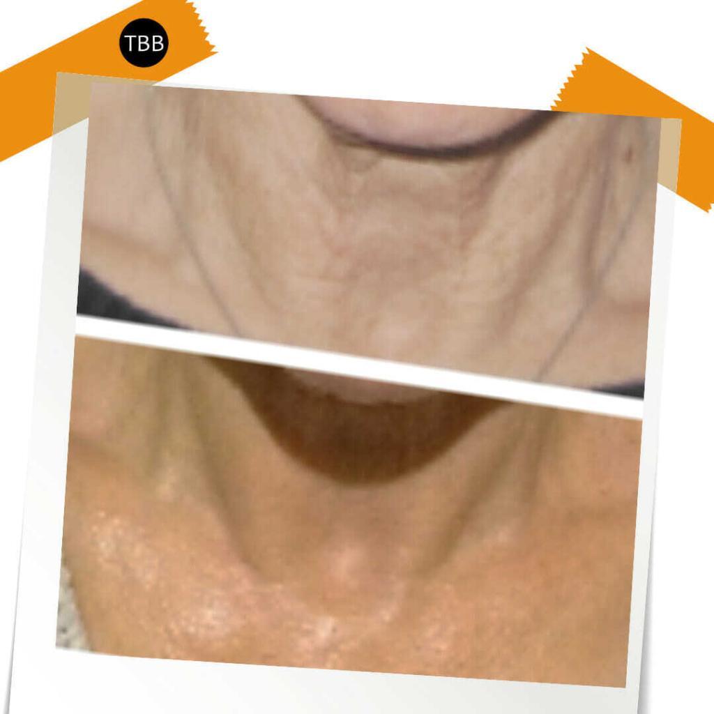 Neck treatment, bespoke facials, Caci, Advanced facials, facials,