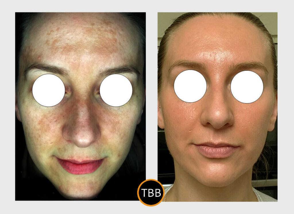 Cosmelan depigmentation peel