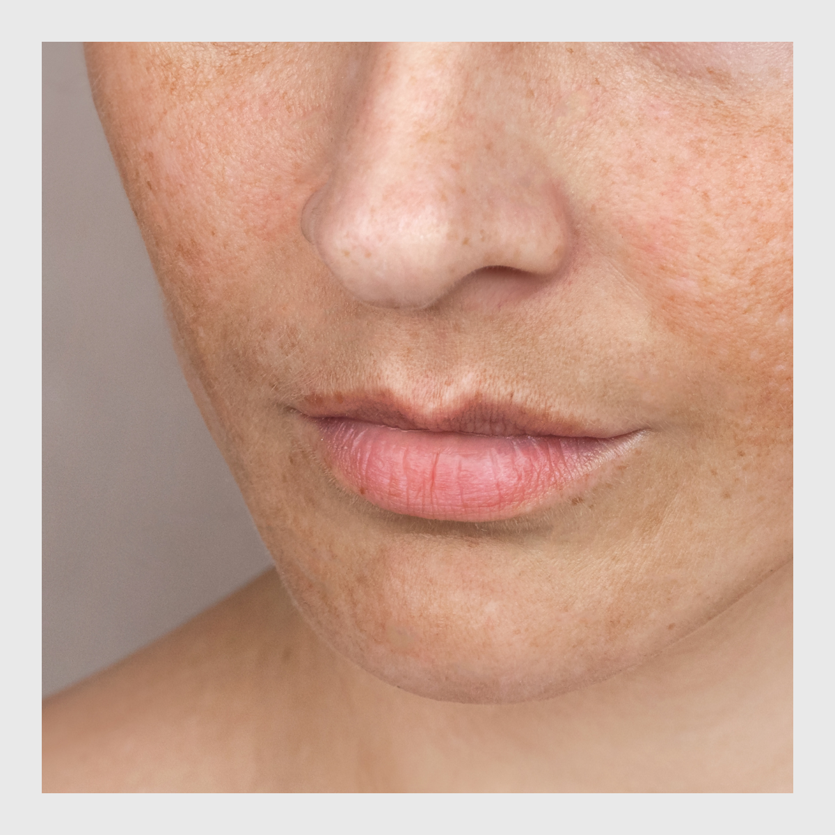 Cosmelan, Cosmelan depigmenting programme, pigmentation, dark spots, blemishes, melasma