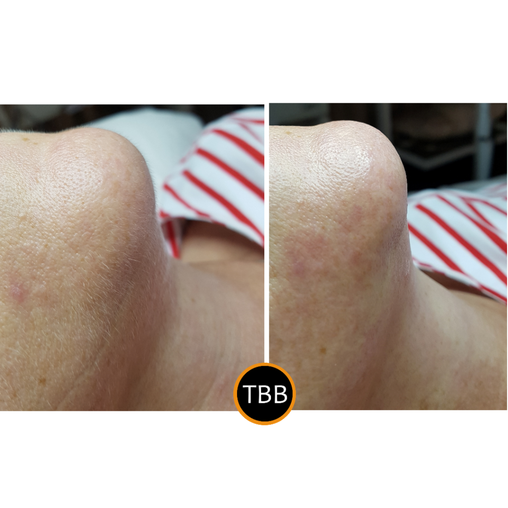 DMK Alkaline Wash before and after