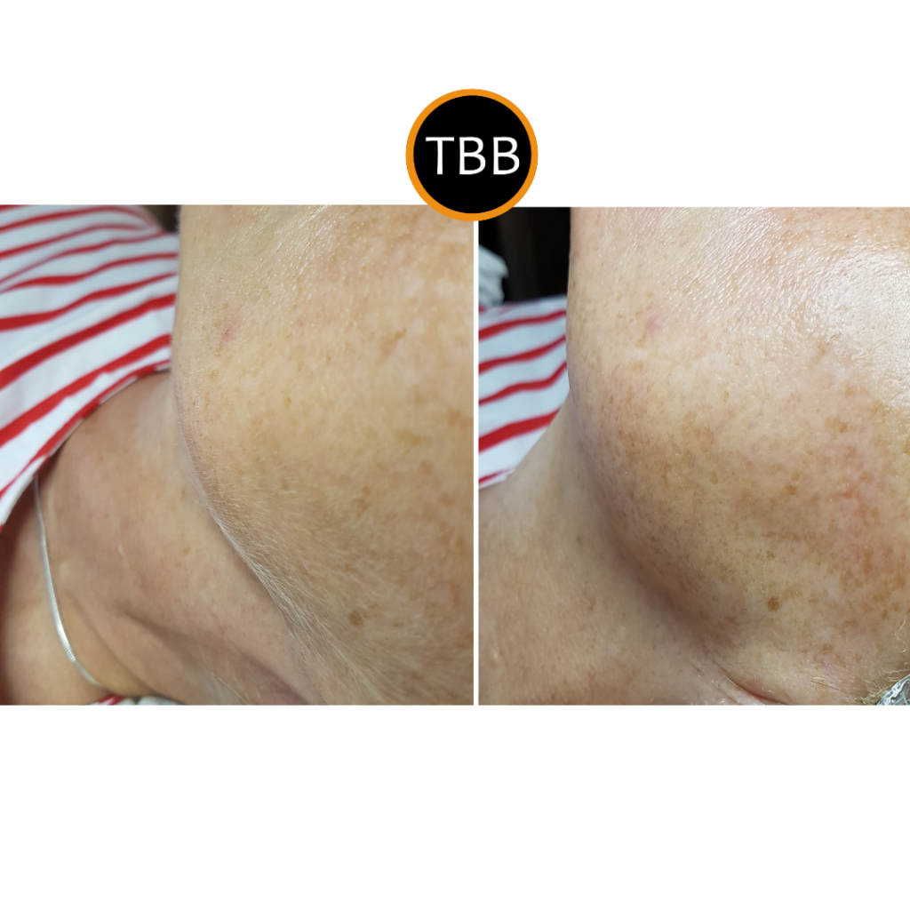 DMK Alkaline wash before and after images