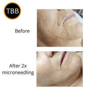 Before and after 2x microneedling