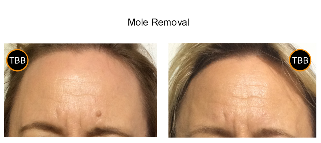 Blemish Removal Treatment - Mole removal