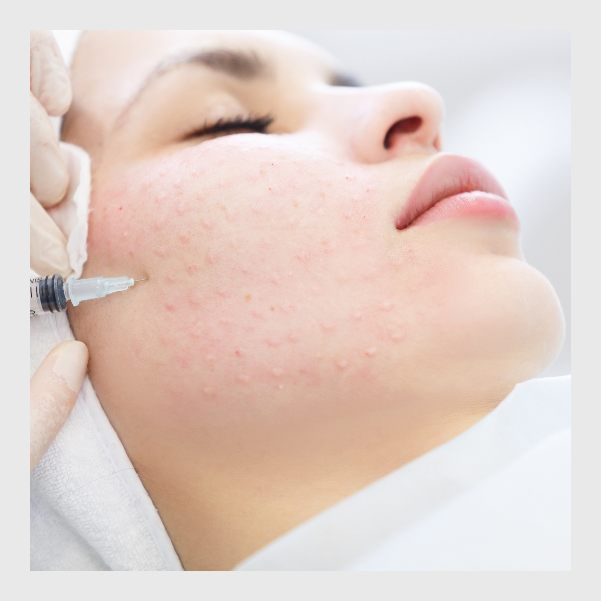 Mesotherapy Meso Infinity, skin rejuvenation, Skin treatments, skin health, injectable mesotherapy, no needle mesotherapy,