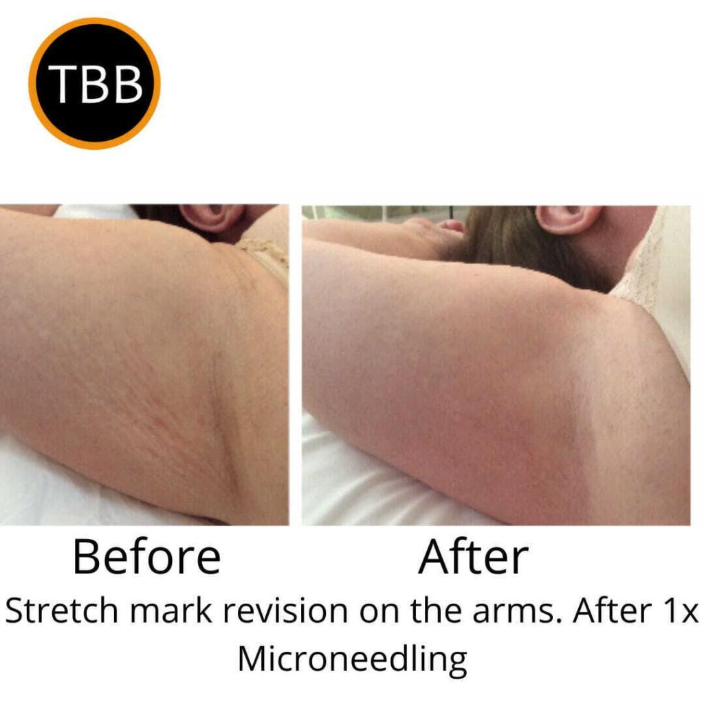 Microneedling for stretch marks