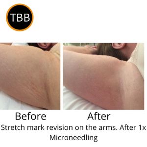Microneedling for stretch marks