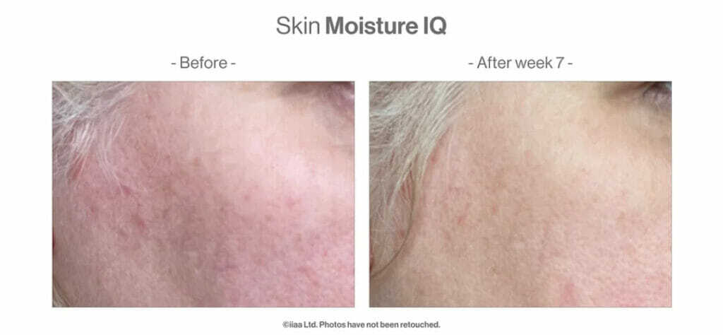 ANP Skin Moisture IQ