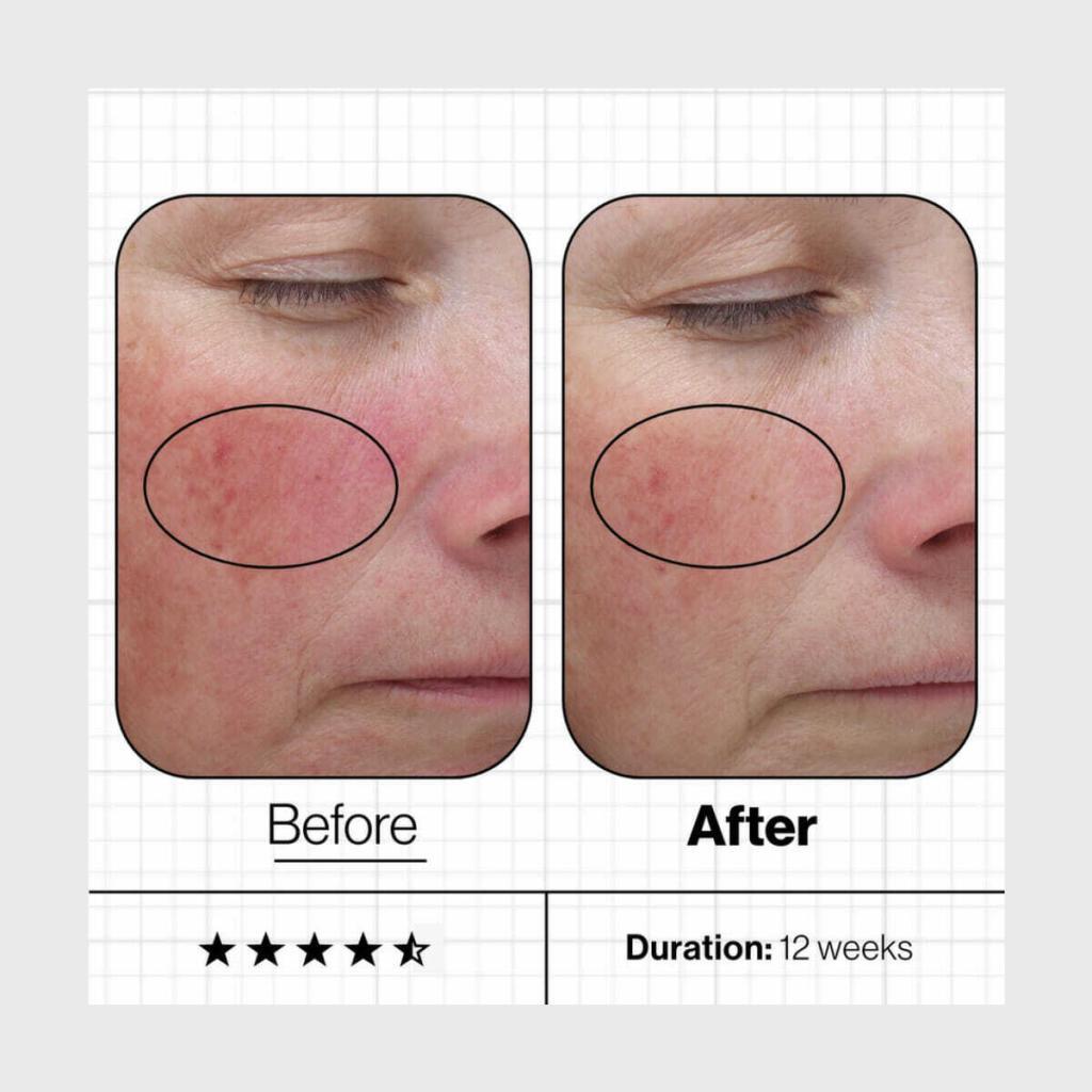 Skin Even IQ Before and after