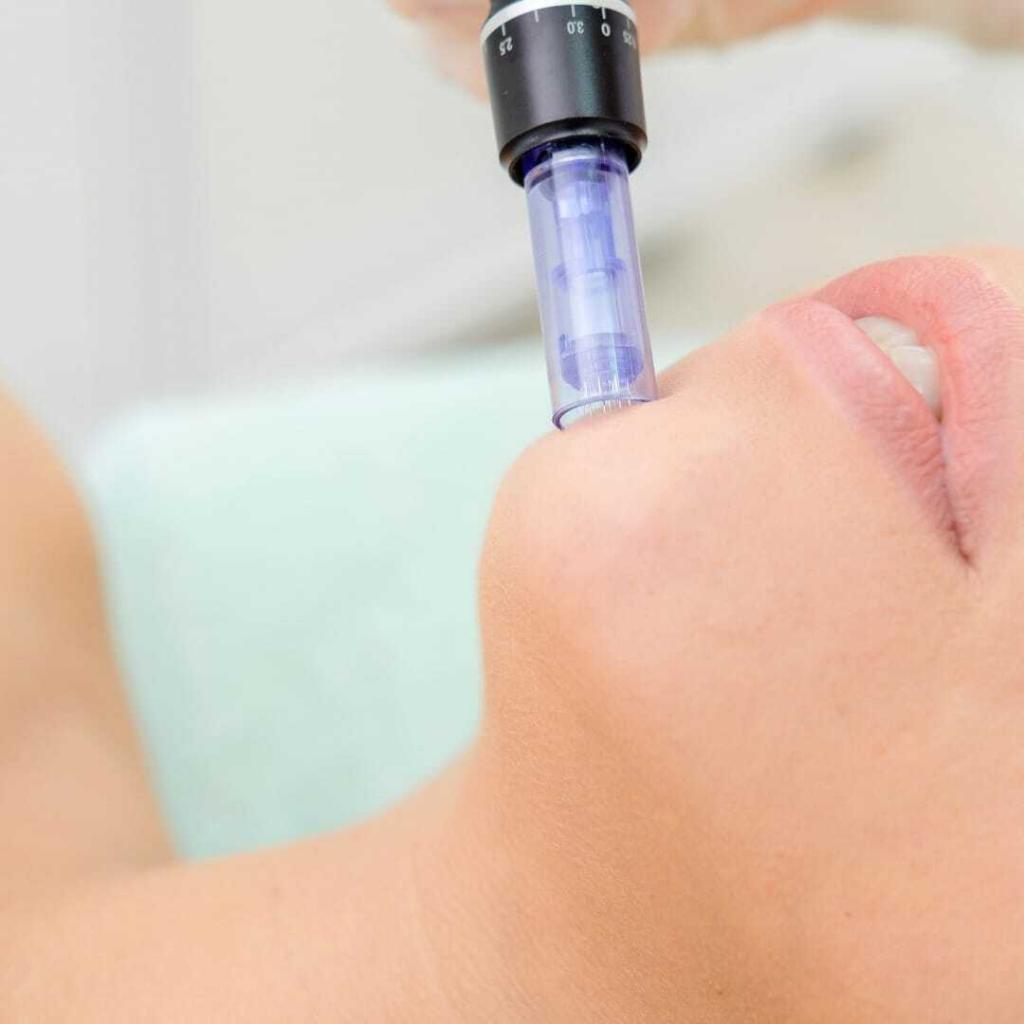 Image of Microneedling