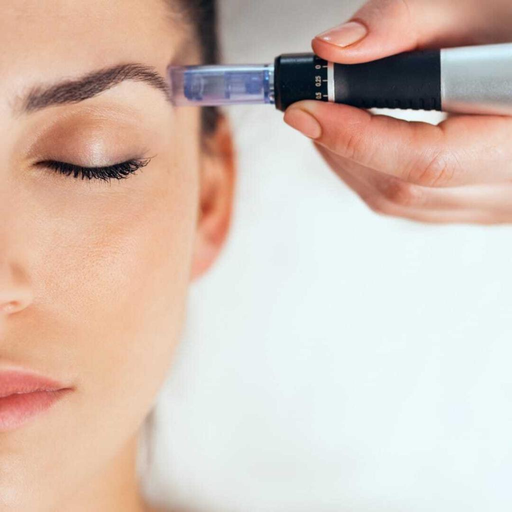 Microneedling