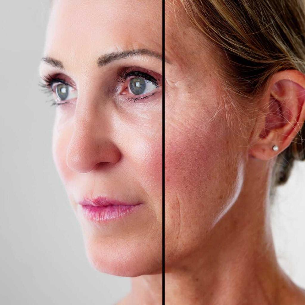 Profhilo skin rejuvenation