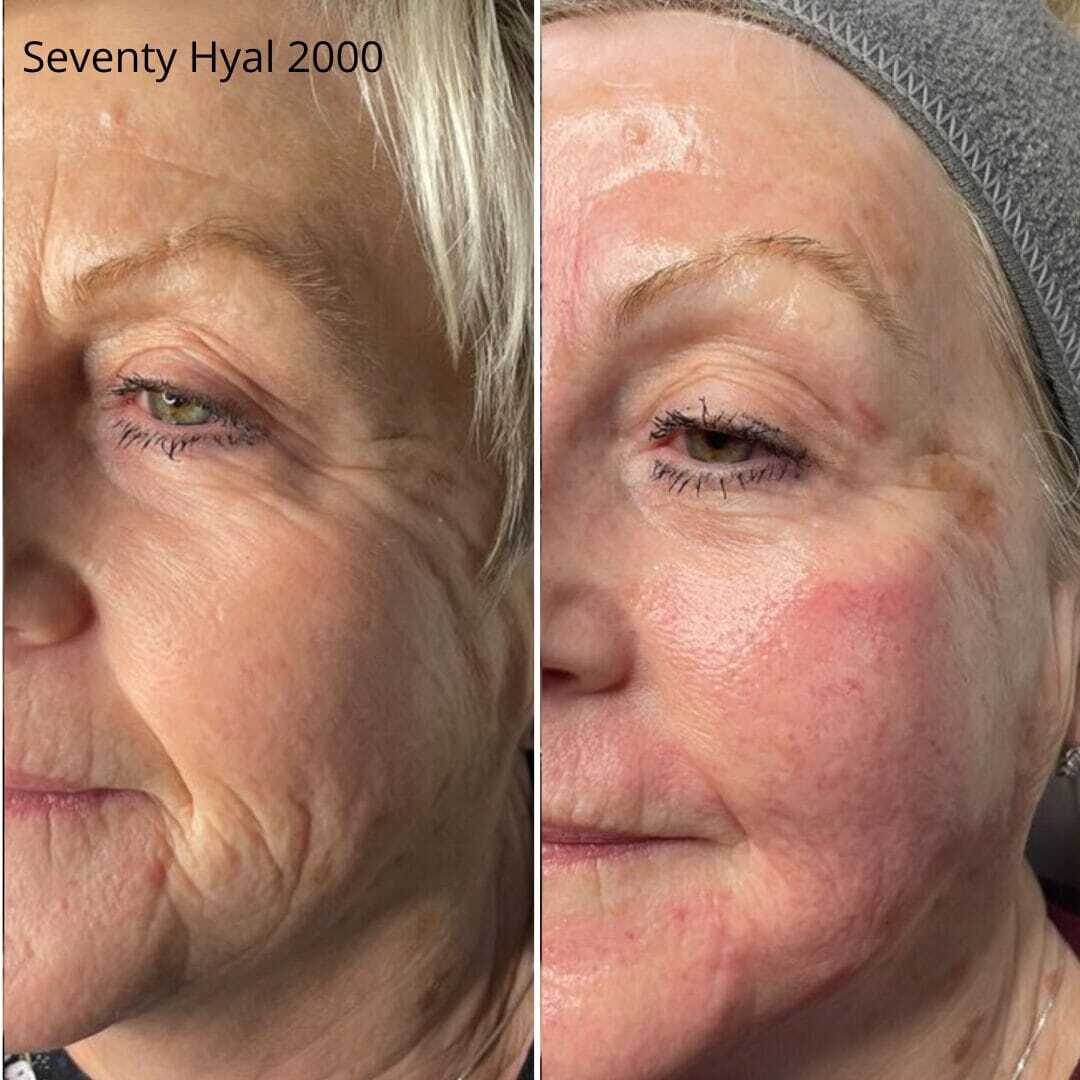 Seventy Hyal (2) Face rejuvenation