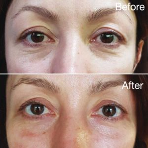 Vitaran (2) Vitaran Before and after eyes