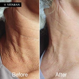 Vitaran Vitaran Neck