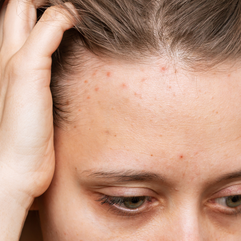 Skin conditions