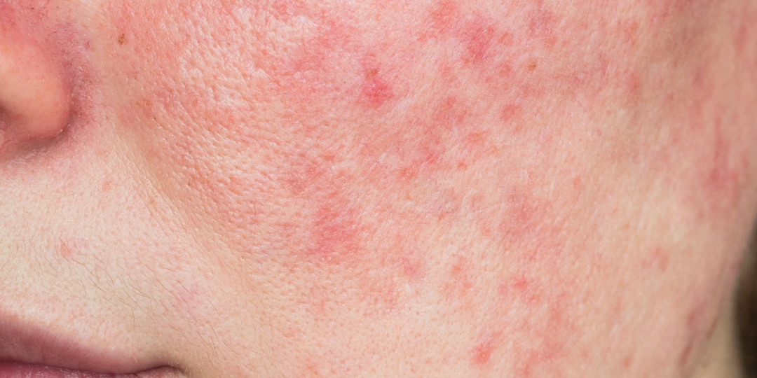 epidermis (2)