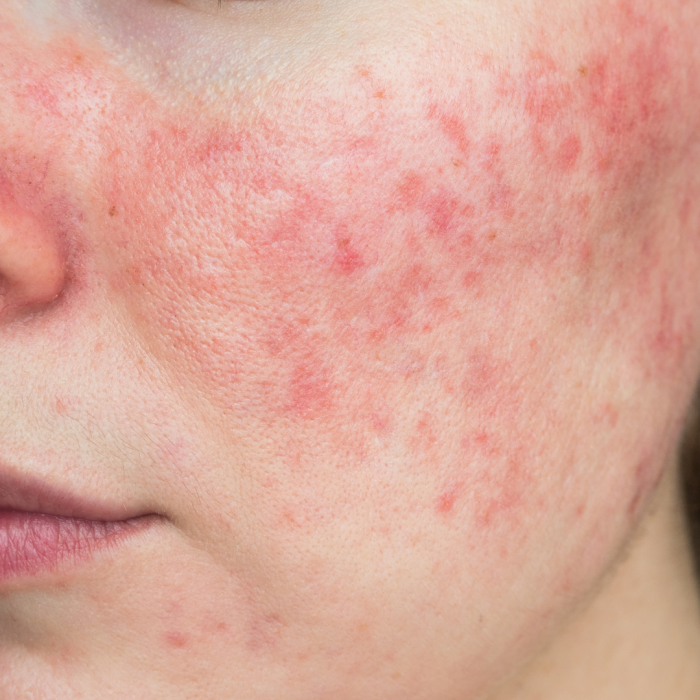 epidermis (2)