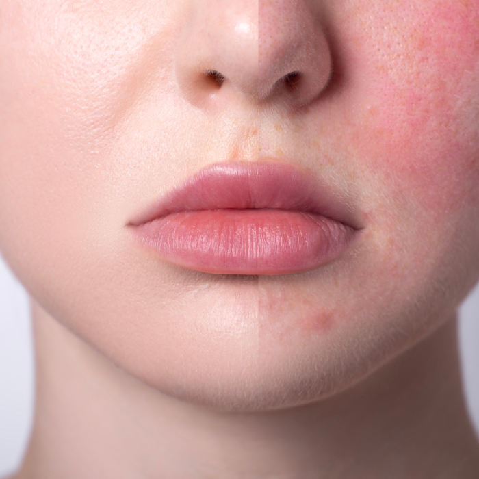 Skin Redness, rosacea, skin, reactive skin