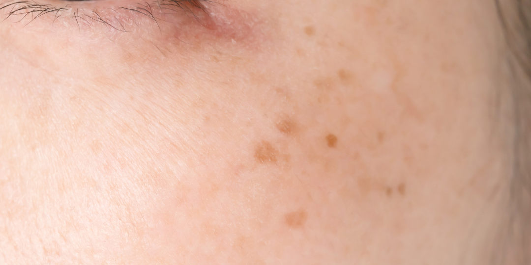 dark patches, dark patches on your skin, skin, pigmentation, brown spots, freckles, melasma, uneven skin tone, pigment
