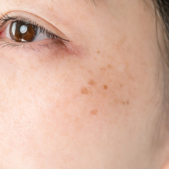 dark patches, dark patches on your skin, skin, pigmentation, brown spots, freckles, melasma, uneven skin tone, pigment
