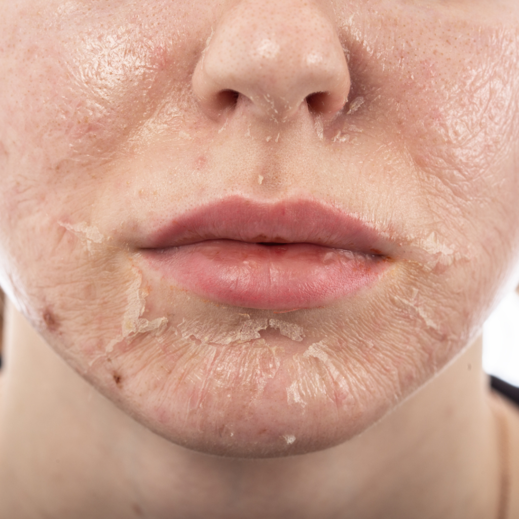 Skin Peels, skin treatments, plateau