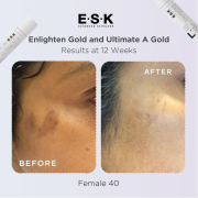 before and after image of pigmentation on a 40 year old womans cheek
