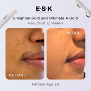 Before and after of pigmentation reduction around the mouth on a 38 year old female