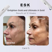 Before and after of a woman using the ESK Golden Pigmentation Duo