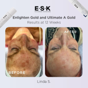Before and after of a woman with pigmentation on her forehead