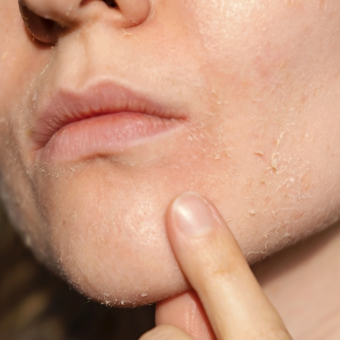 Image of a woman with flakey skin