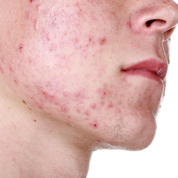 image of skin presenting with acne, papules and pustules, closed comedones and whiteheads and inflammation
